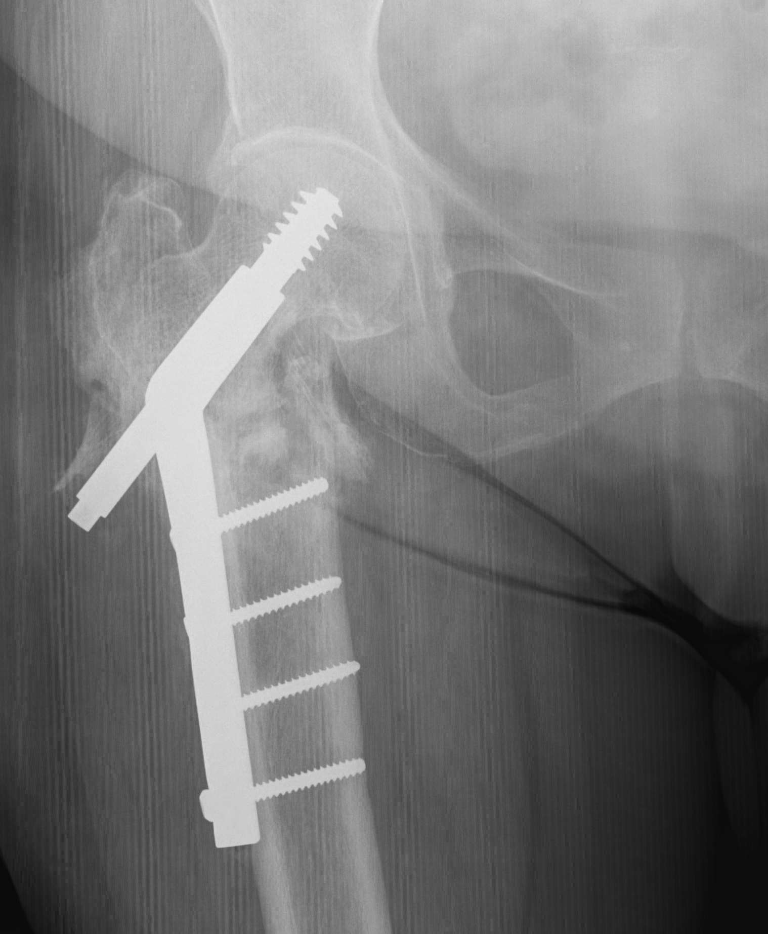 Intertrochanteric Fracture Barrel Impingement